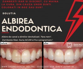 Albirea endodontica, Chisinau/ DAVINCI dental clinic